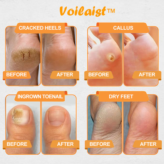 Voilaist™ 🐝Bee Venom Lymphatic Drainage & Slimming Foot SoakBeads【Doctorrecommendation-For alllymphatic problems and obesity】